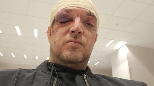 TUČA U STANU NA KARABURMI: Zoran Marjanović pretučen tokom večeri sa društvom, svi bili u alkoholisanom stanju (FOTO) – napad u Beogradu