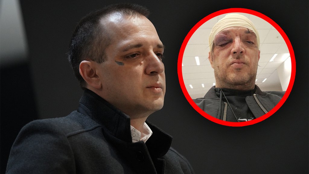 ŽESTOK OBRAČUN U STANU NA KARABURMI: Izbijeni zubi i kontuzija mozga – detalji napada na Zorana Marjanovića (FOTO) – napad u stanu na Karaburmi