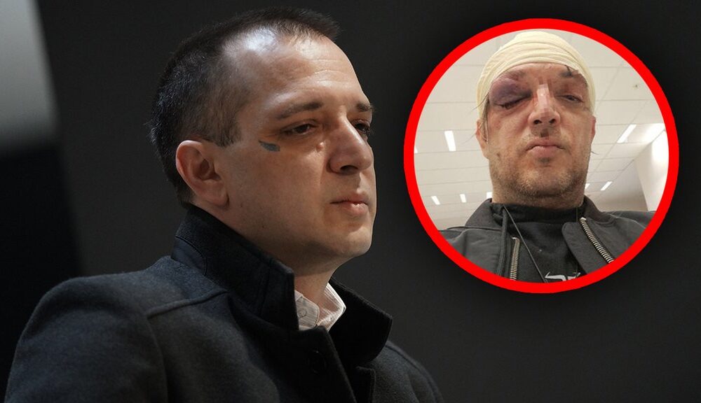 ZORAN MARJANOVIĆ PREKIDA TIŠINU POSLE BRUTALNOG SUKOBA: Odbio da otkrije napadača policiji, javnost u šoku (FOTO) – napad u Beogradu