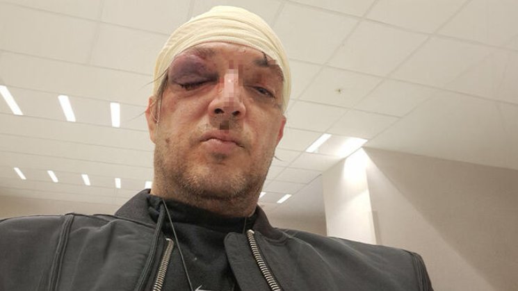 KARAMBOL NA PALILULI: Zoran Marjanović brutalno pretučen, ljubavna drama prerasla u haos, a napadač i dalje nepoznat – napad u Beogradu